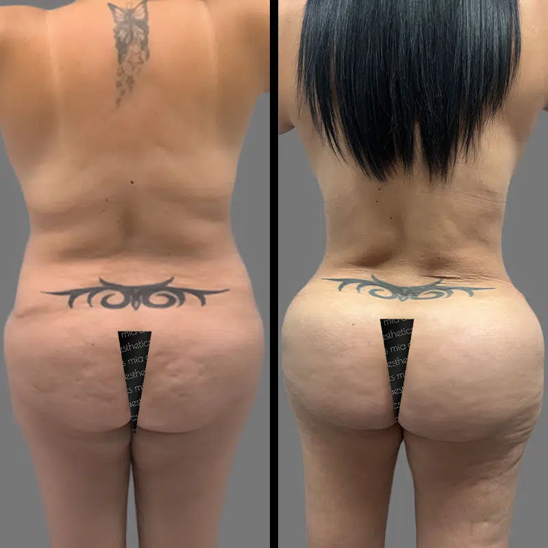 Dr. Giorgis BBL - Before & After 1