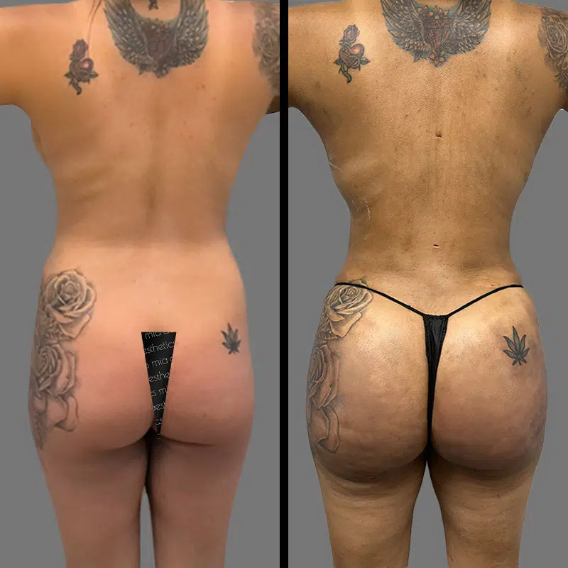 Dr. Giorgis BBL - Before & After 2
