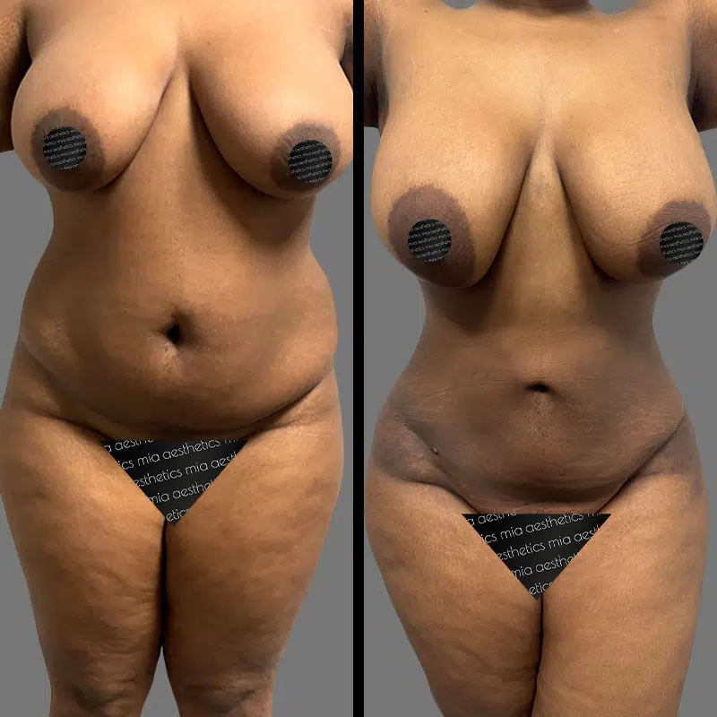 Dr. Giorgis Lipo 360 - Before & After 1