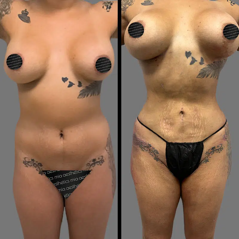 Dr. Giorgis Lipo 360 - Before & After 1