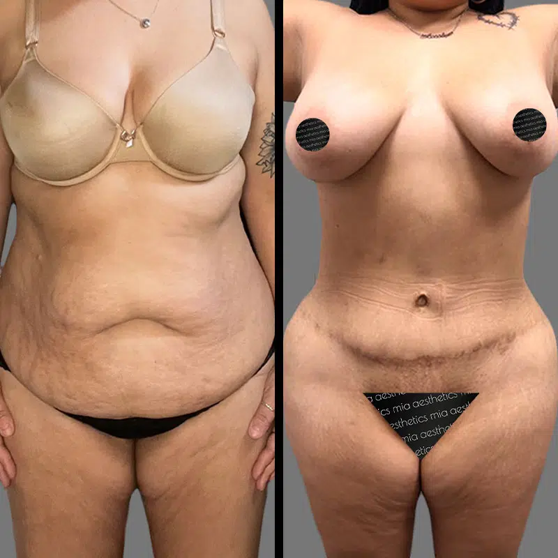 Dr. Giorgis Tummy Tuck - Before & After 1