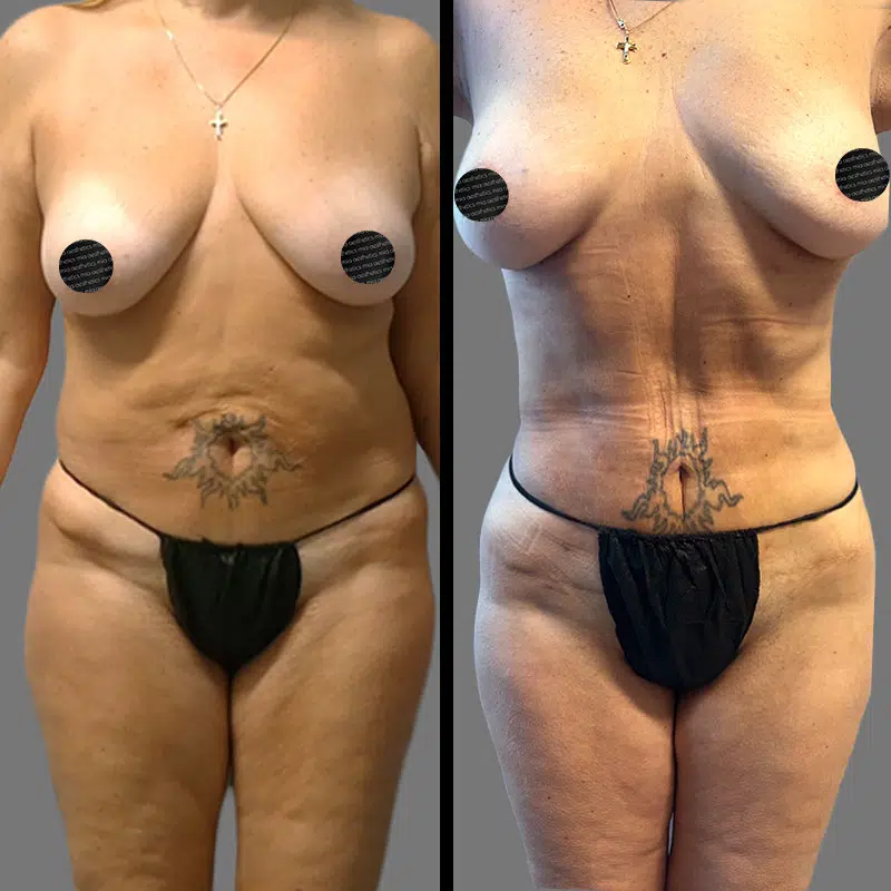 Dr. Horowitz Lipo 360 - Before & After 2