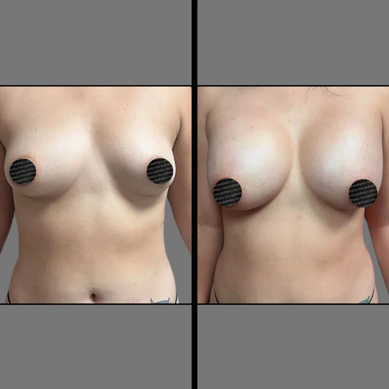 Dr. Rozentsvit Breast Augmentation - Before & After 1