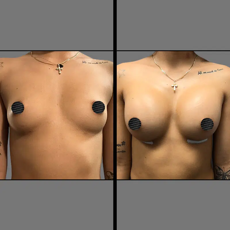 Dr. Rozentsvit Breast Augmentation - Before & After 3