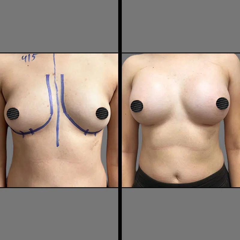 Dr. Rozentsvit Breast Augmentation - Before & After 4