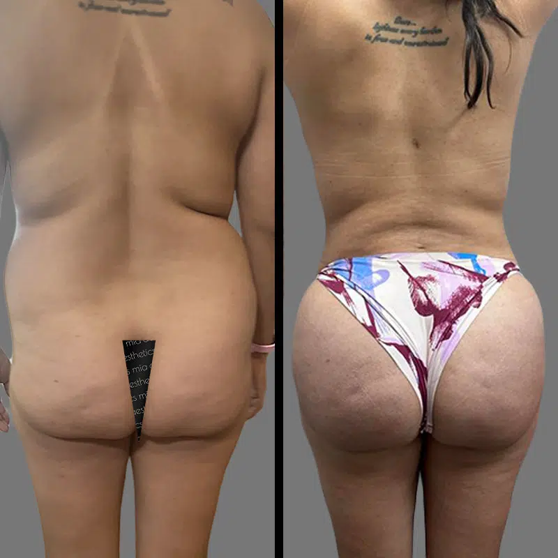 Dr. Rozentsvit BBL - Before & After 1