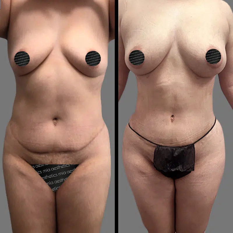 Dr. Rozentsvit Lipo 360 - Before & After 1