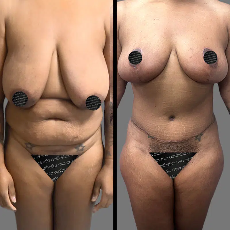 Dr. Rozentsvit Mommy Makeover - Before & After 1