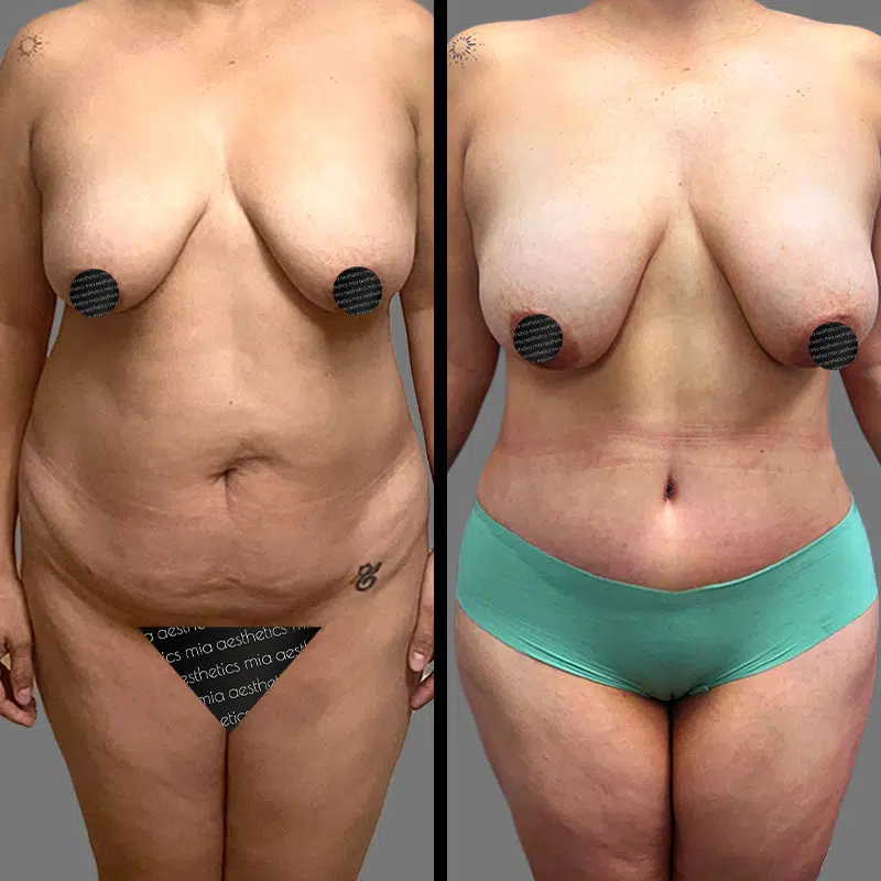Dr. Rozentsvit Tummy Tuck - Before & After 1