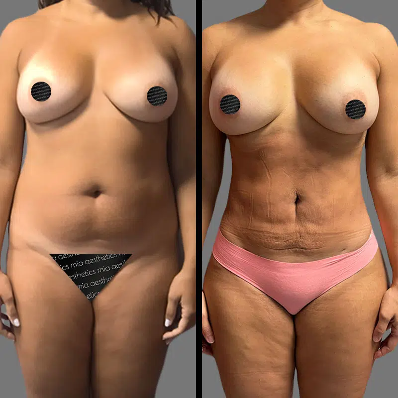 Dr. Scroggins Lipo 360 - Before & After 2