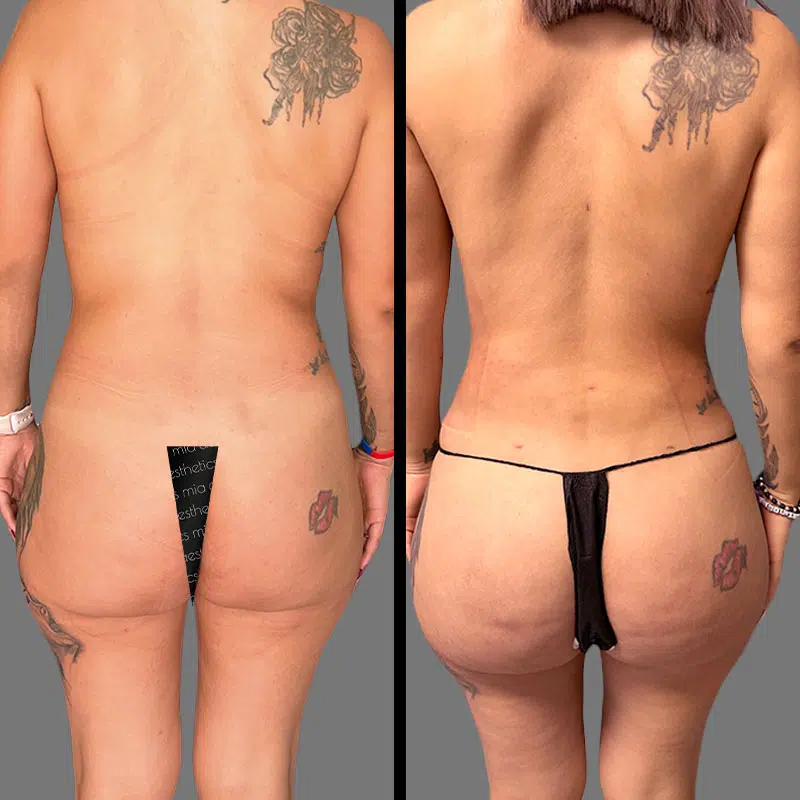 Dr. Shaikh BBL - Before & After 1