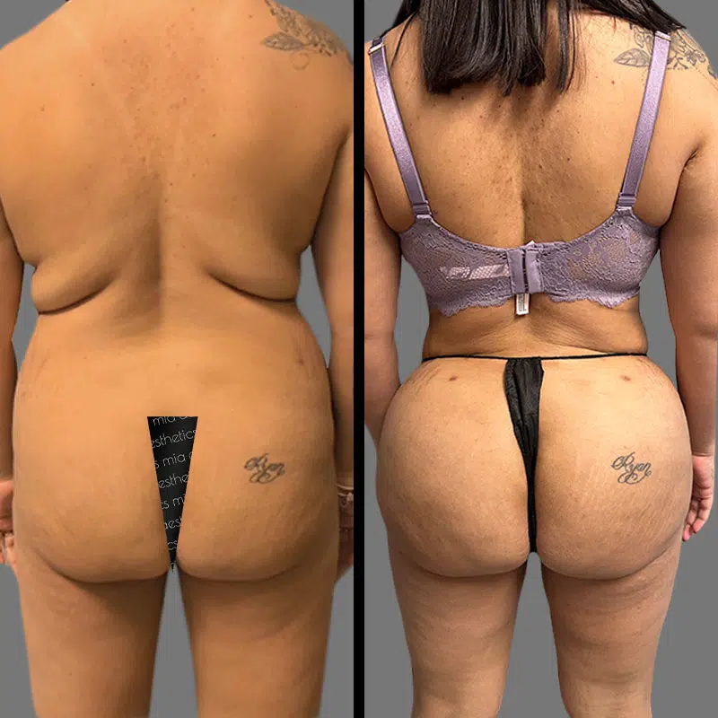 Dr. Shaikh BBL - Before & After 2
