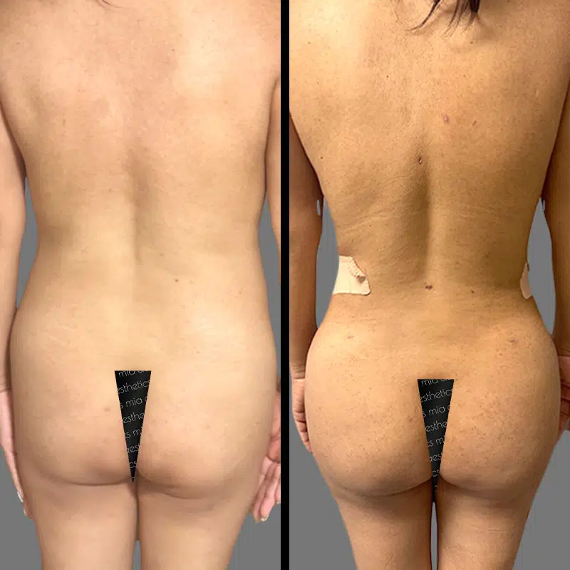Dr. Shaikh BBL - Before & After 3