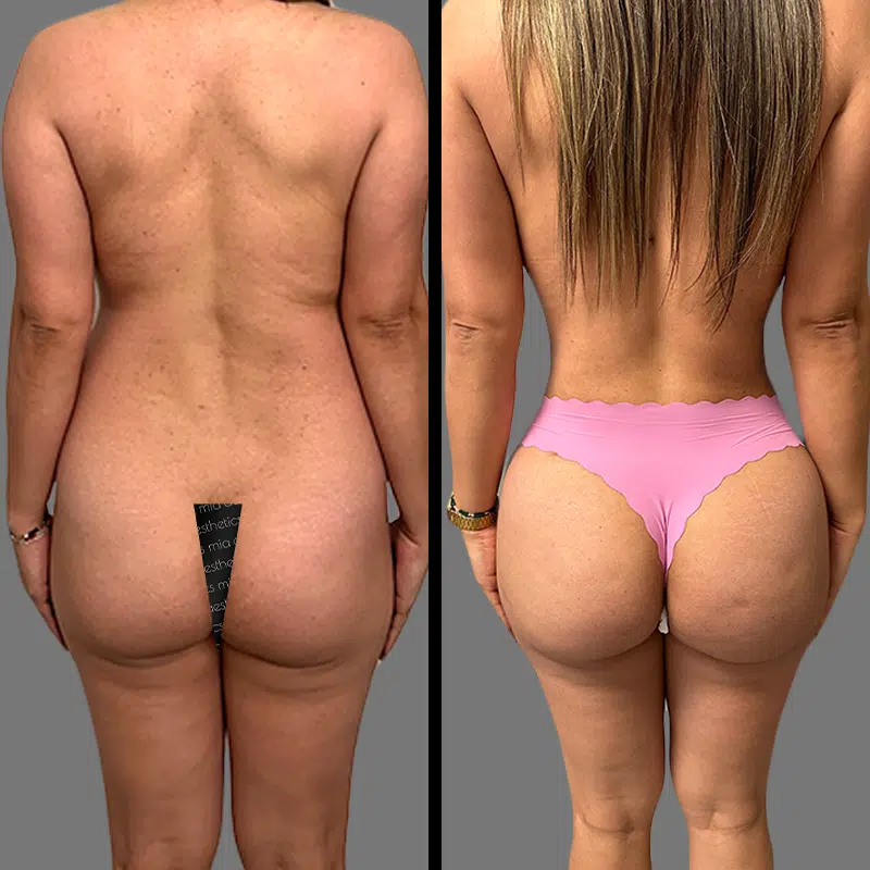 Dr. Shaikh BBL - Before & After 4