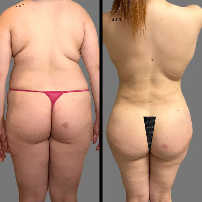 Dr. Shaikh BBL - Before & After 5