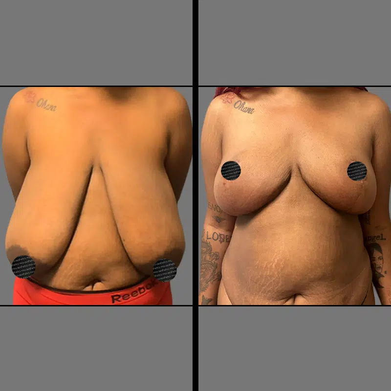 Dr. Shaikh Breast Reduction - Before & After 1