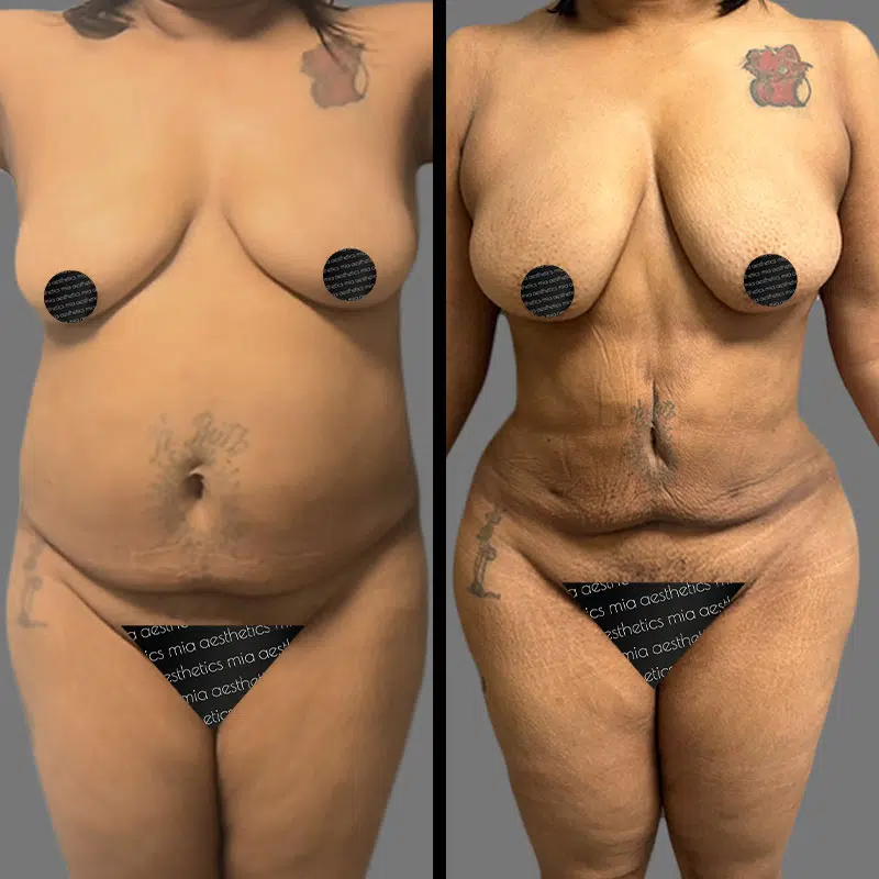 Dr. Shaikh Lipo 360 - Before & After 1