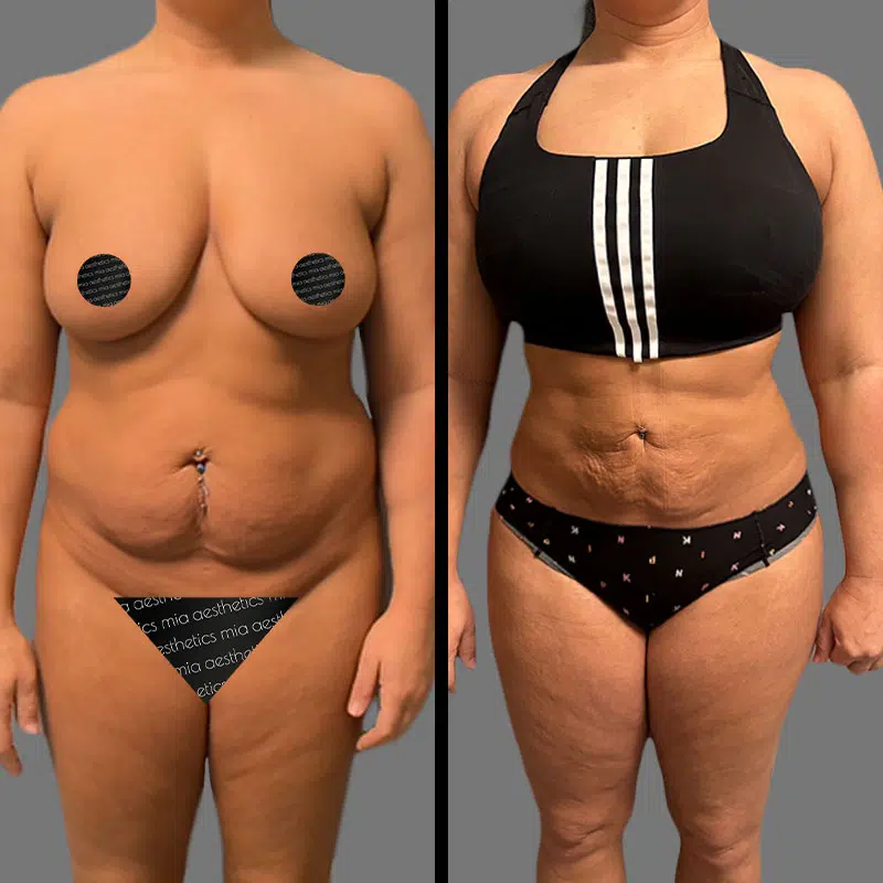 Dr. Shaikh Lipo 360 - Before & After 2