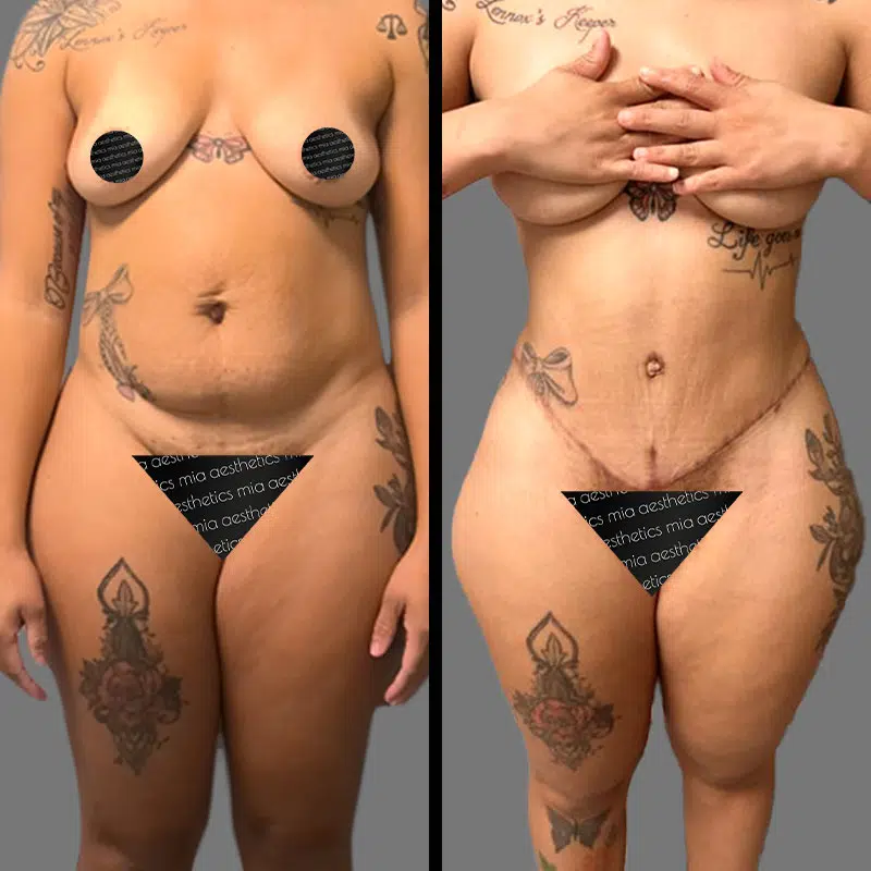 Dr. Shaikh Tummy Tuck - Before & After 1