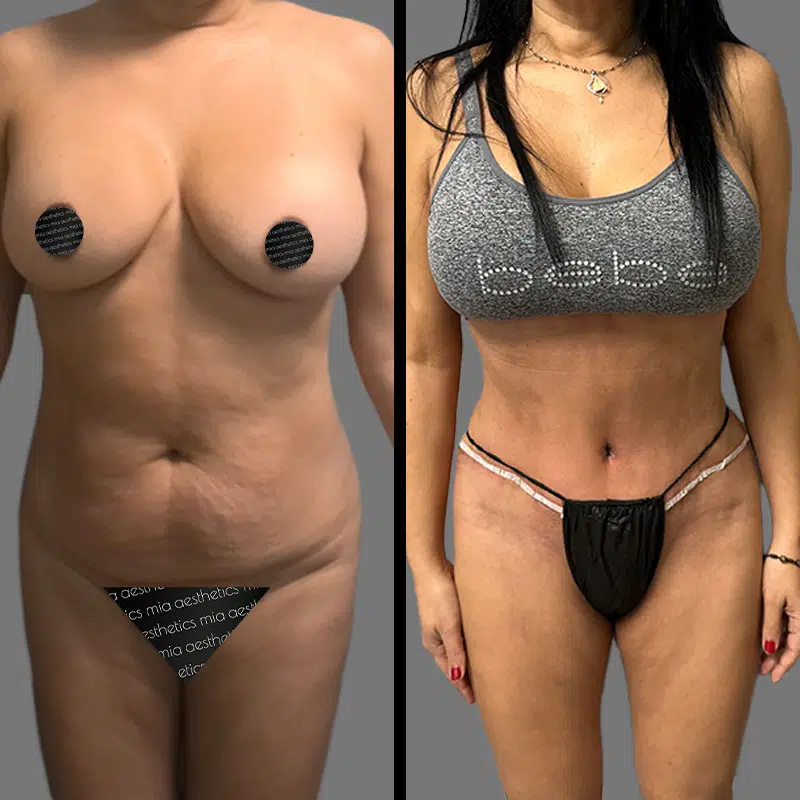 Dr. Shaikh Tummy Tuck - Before & After 2
