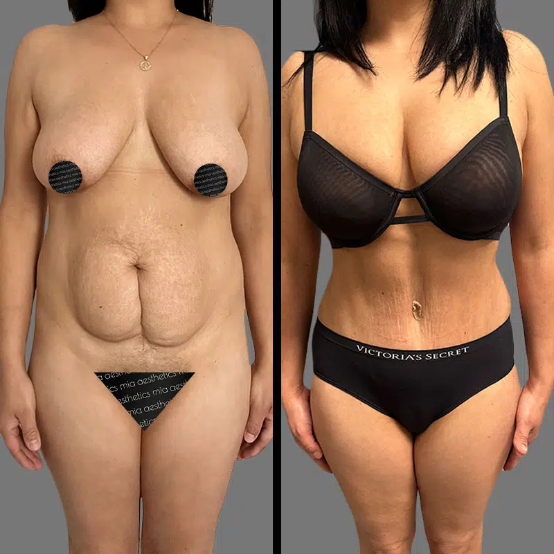Dr. Shaikh Tummy Tuck - Before & After 3
