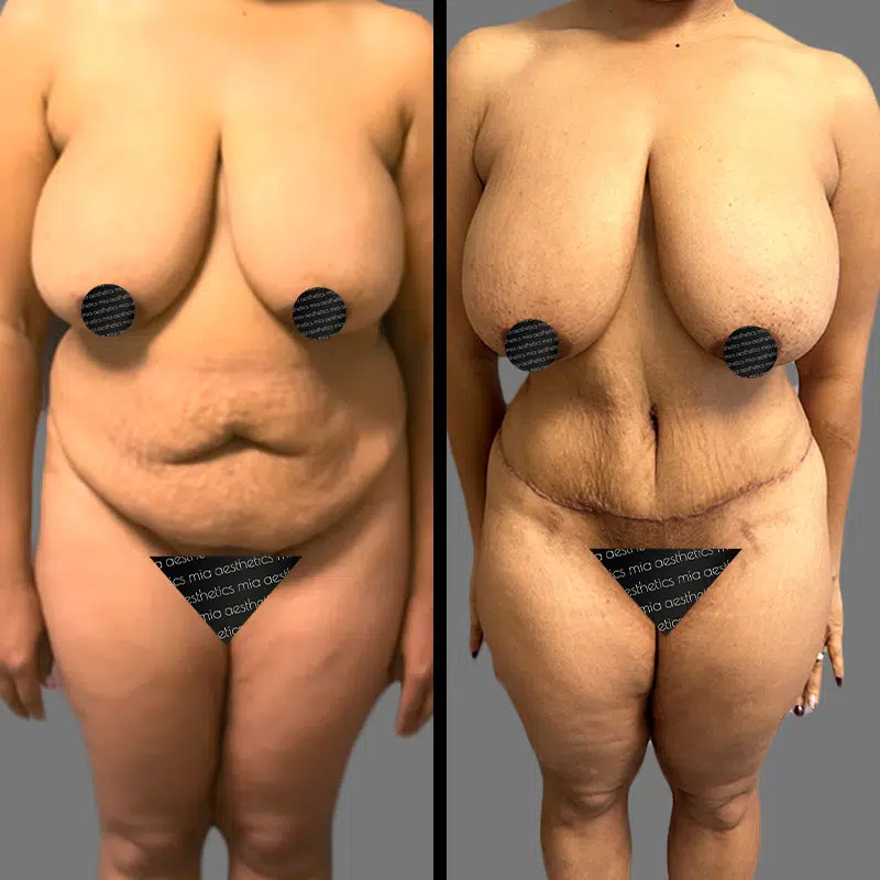 Dr. Shaikh Tummy Tuck - Before & After 4