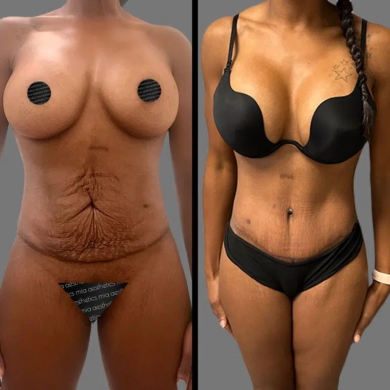 Dr. Shaikh Tummy Tuck - Before & After 5
