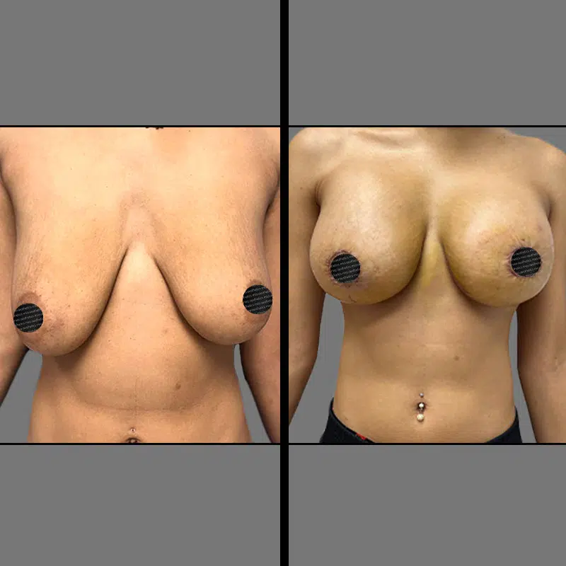 Dr. Towle Augmentation & Breast Lift - Before & After 1