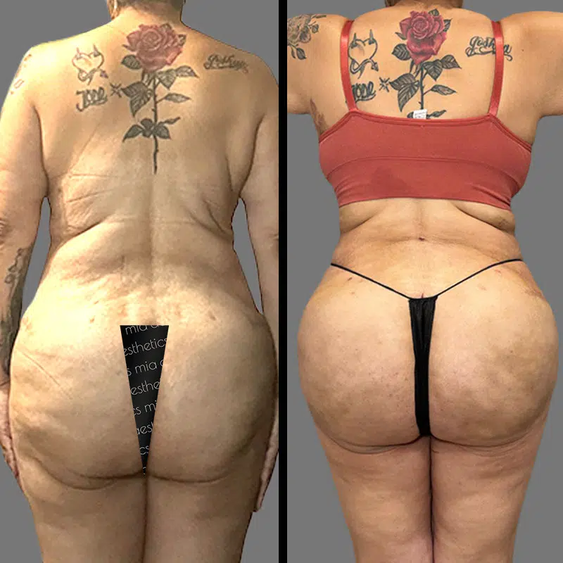Dr. Towle BBL - Before & After 1