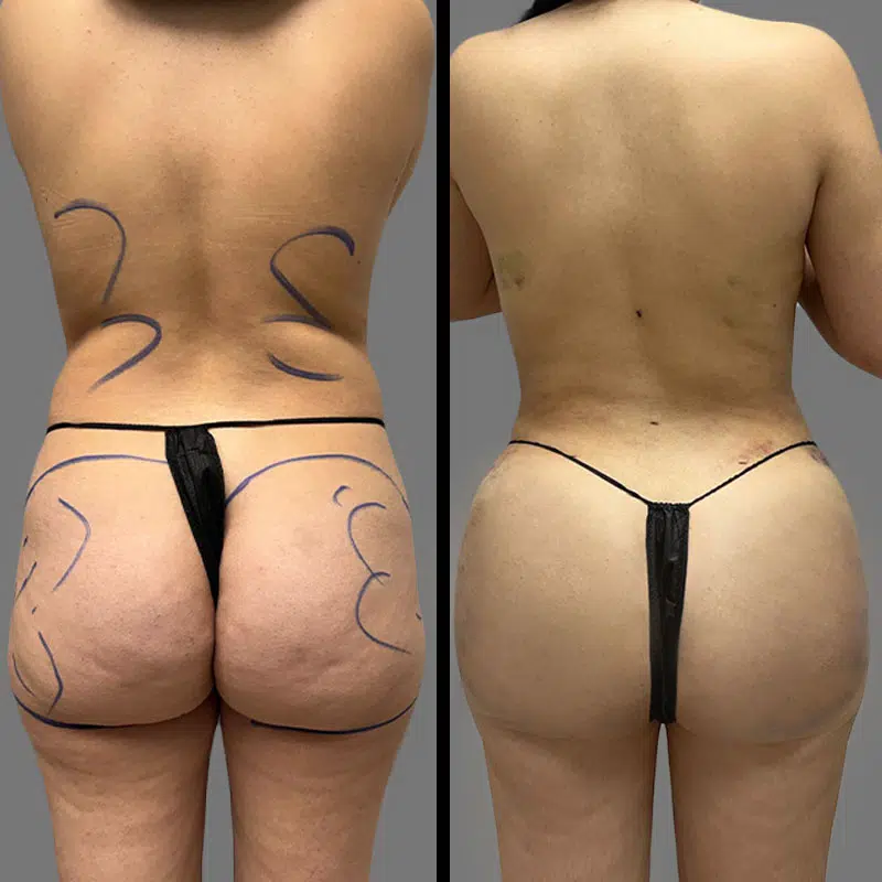 Dr. Towle BBL - Before & After 2