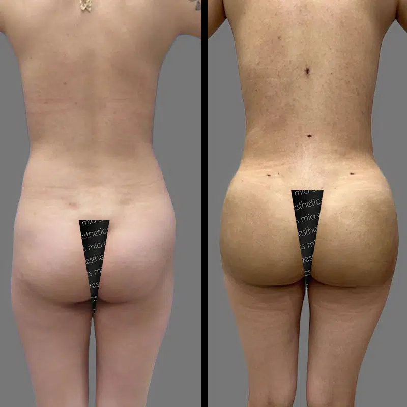 Dr. Towle BBL - Before & After 3