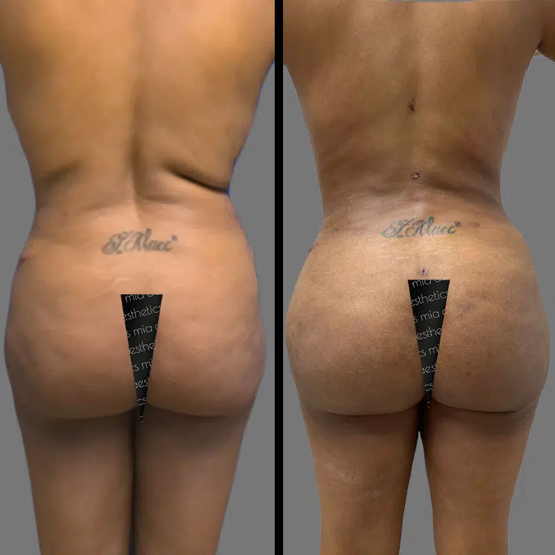 Dr. Towle BBL - Before & After 4