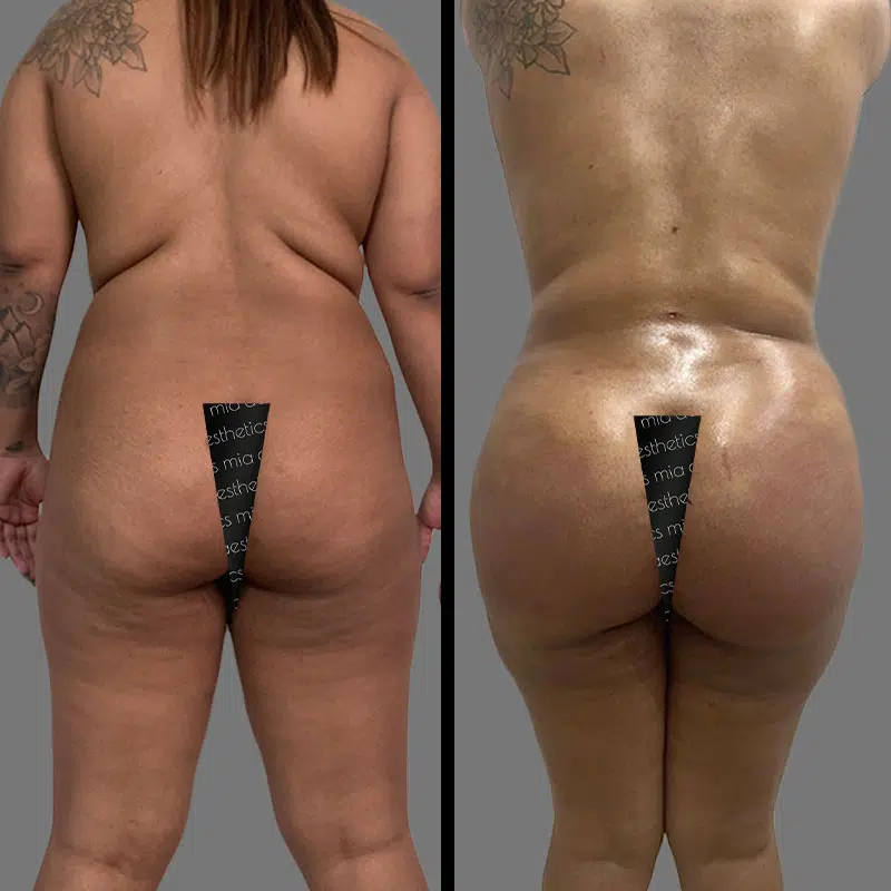 Dr. Towle BBL - Before & After 5