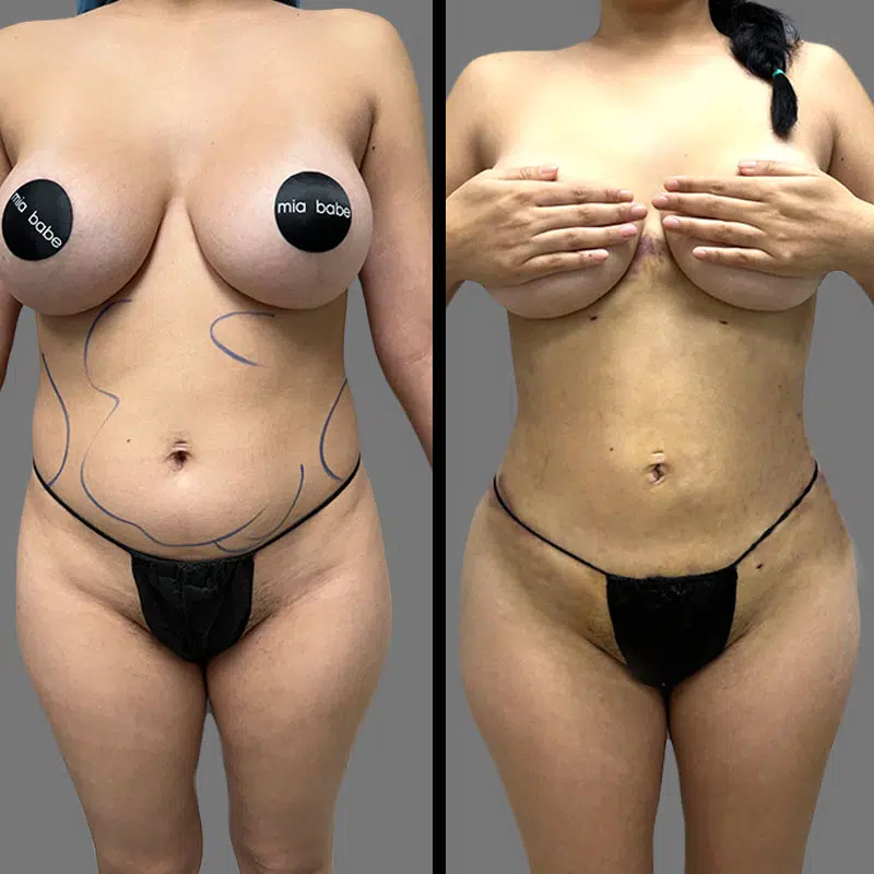 Dr. Towle Lipo 360 - Before & After 1