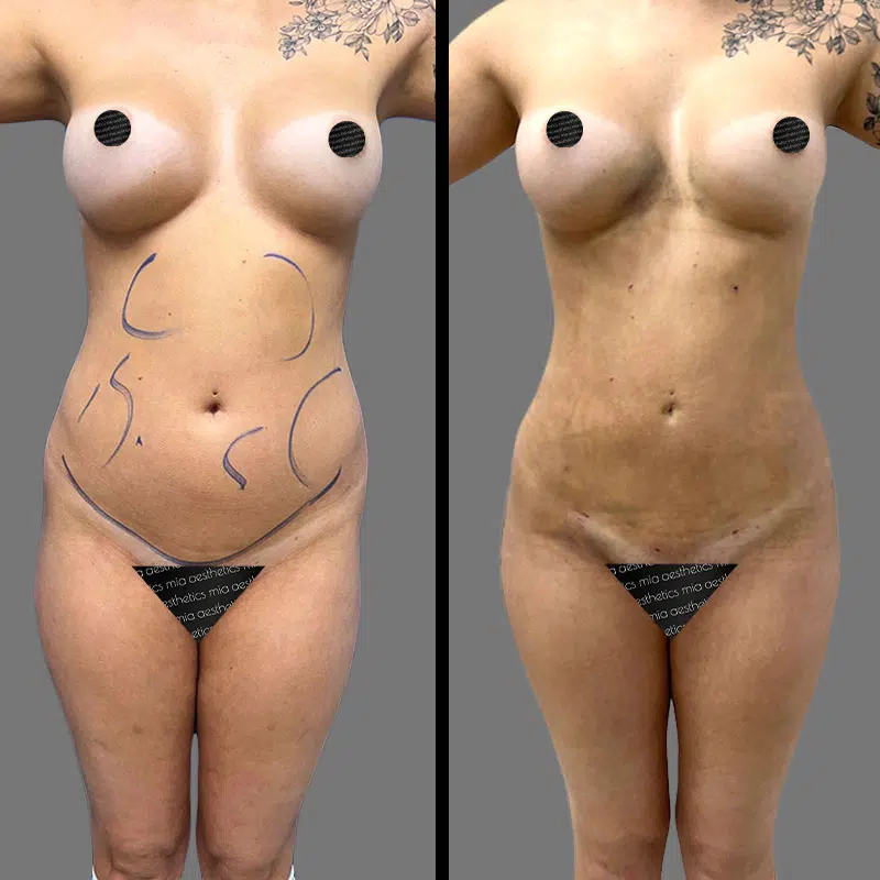 Dr. Towle Lipo 360 - Before & After 2