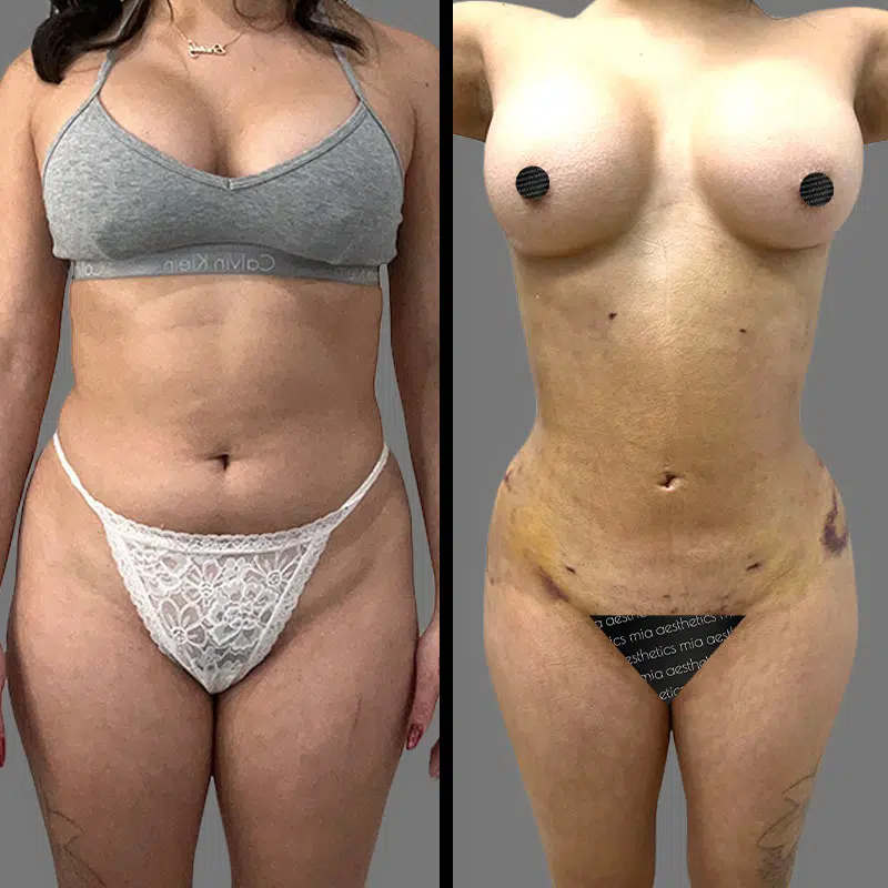 Dr. Towle Lipo 360 - Before & After 3
