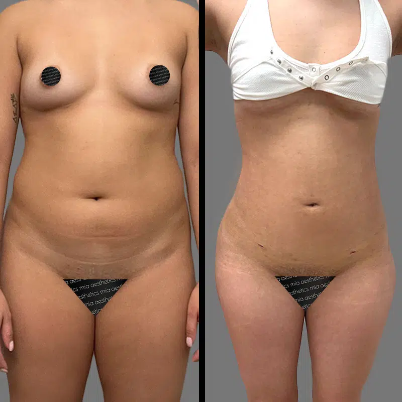 Dr. Towle Lipo 360 - Before & After 5