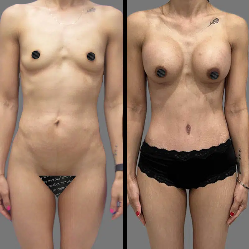 Dr. Towle Mommy Makeover - Before & After 2