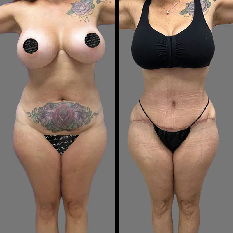 Dr. Towle Tummy Tuck - Before & After 1