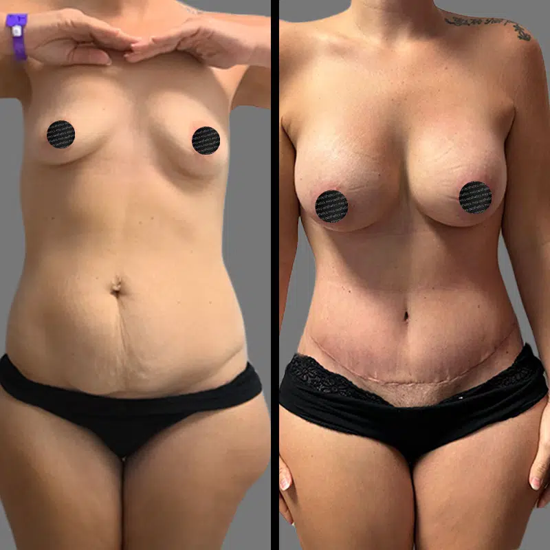 Dr. Valauri Mommy Makeover - Before & After 1