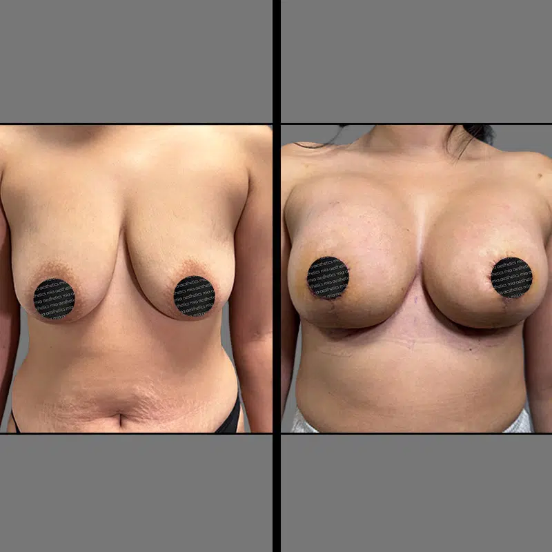 Dr. Wright Breast Augmentation & Lift - Before & After 1