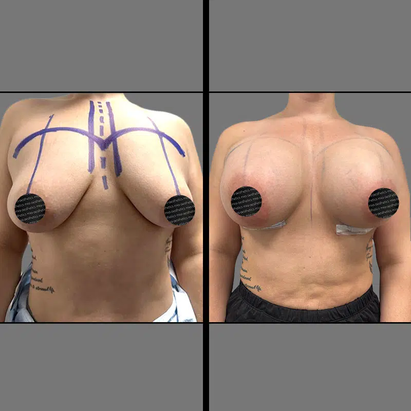 Dr. Wright Breast Augmentation - Before & After 1