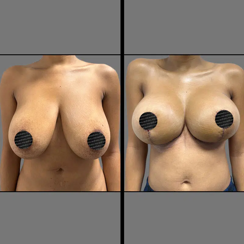 Dr. Wright Breast Augmentation - Before & After 2