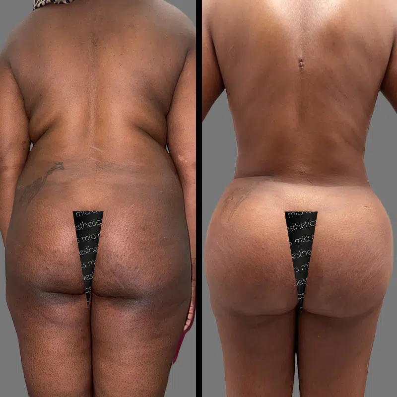 Dr. Wright BBL - Before & After 1