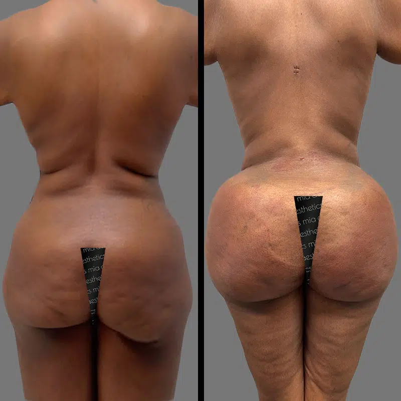 Dr. Wright BBL - Before & After 2