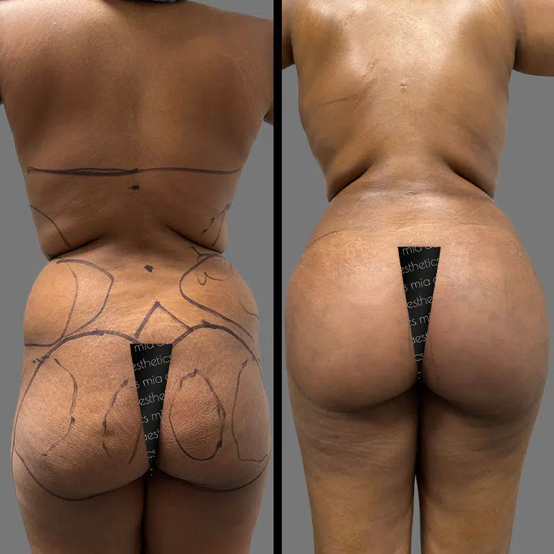 Dr. Wright BBL - Before & After 3
