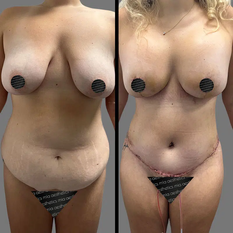 Dr. Wright Mommy Makeover - Before & After 1