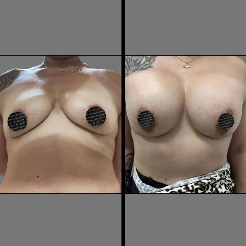 Dr. Xu Breast Augmentation - Before & After 2