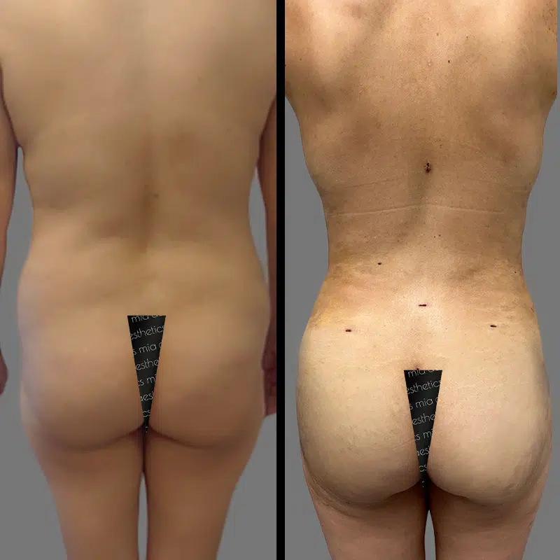 Dr. Xu BBL - Before & After 1