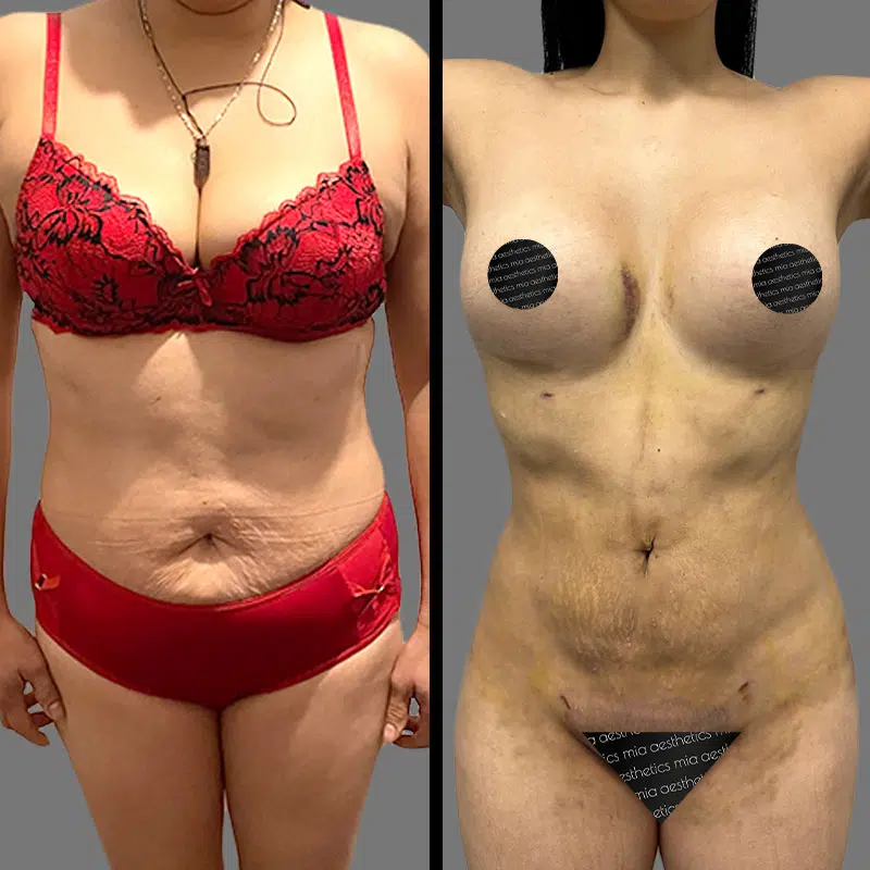 Dr. Xu Lipo 360 - Before & After 2